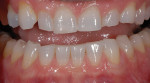 Figure 4  Retracted view shows excessive uneven wear and stress corrosion on teeth Nos. 8 and 9.