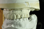 It is determined that 15 mm on the anterior and 13 mm on the posterior sector are needed or the final restoration.