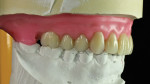 Denture teeth have freedom of placement
in centric with the back stop acting as a locking mechanism for stability.