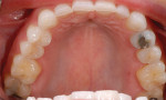 Figure 5  View of maxillary arch shows severe wear on the anterior teeth and moderate wear on the premolars.