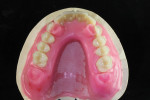 Occlusal view of the anterior stops. The wax build on the lingual is for structural strength.