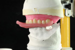 The occlusal stop replaces the bite jig, not changing the OVD. The jig is still needed to reset the denture teeth.