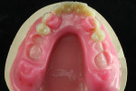 The posterior teeth are removed posterior teeth to improve access to implant without damage tooth integrity.