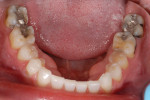 Figure 6  Mandibular arch exhibiting structurally compromised teeth, caries, erosion, and generalized wear.