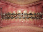 Retracted front view of the patient during orthodontic treatment.