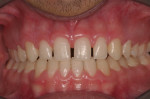 Post-orthodontic retracted front view.