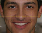 Eyebrow-to-chin view of the patient’s natural smile with provisionals.