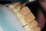 The wax restorations were separated using a Smile Line ultra thin knife.