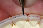 The newly reduced facial incisal edge was re-marked.