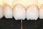 Vanilla Universal stain was modified
with Universal Red to accent incisal lobe detail.
