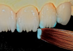 An exact piece of OE1 (Opal Clear) was placed in the outermost interproximal incisal troughs.