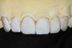 TI1 (high-value enamel) was placed over the effects to full contour.