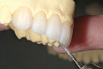 The lingual incisal edge bevel was cut to duplicate the preoperative model.