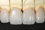 View of the glazed and fired IPS e.max restorations.