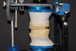 Figure 12  Mandibular incisors were waxed to ideal length and brought into occlusion. Incisal guide pin was set to this height, and idealized contours of the mandibular posterior teeth were then completed.