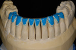 Figure 14  Mandibular working cast showing no preparation on lower anterior teeth.
