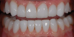 Figure 16  Retracted view of final restorations demonstrating leveled incisal edge position and an increase in maxillary incisal edge length of 2.5 mm.