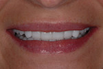Figure 17  Maxillary tooth display in a full smile still falls within acceptable esthetic limits, with incisal edges following the lower lip line.