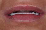 Figure 18  Lips in repose reveals both maxillary and mandibular incisal edges of the definitive restorations within the normal range.