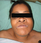 Figure 1  Extraoral initial examination showed moderate edema of the left face.