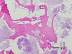 Figure 15  Histologies revealing necrotic bone with inflammatory infiltrate.