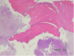 Figure 16  Histologies revealing necrotic bone with inflammatory infiltrate.