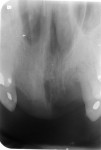 Figure 19  Periapical radiograph of anterior maxillary exposure.