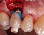 Figure 2  A temporary abutment cylinder was connected to the implant with the temporary crown in place. The next step was to lute the crown to the abutment cylinder with a flowable resin.