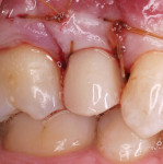 Figure 7  The surgical site was sutured after placement of the temporary restoration. Care was taken to ensure there were no occlusal forces placed on the restoration.