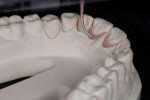 Figure 14. Wax is filled into the modified areas of the cast.