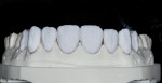 Figure 21. Enamel porcelains are layered overtop internal dentin porcelains.