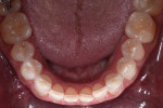 Figure 4. Occlusal view, lower arch, pre-treatment.