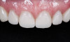 (8.) The arch was scanned with a scan body in place to fabricate a new screw-retained, implant supported restoration.