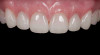 (10.) Immediate posttreatment occlusal view of the final restoration in place with the screw channel sealed with a universal composite.