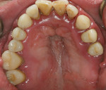 Figure 2  Note the high palatal vault of the maxillary arch.
