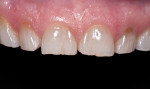 Figure 2. Close-up front view, pre-treatment.