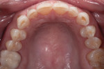 Figure 3. Occlusal view, upper arch, pre-treatment.