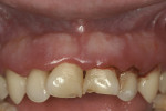 Figure 3  An increased incidence of dental anomalies is seen in patients with T21 as presented here with the nippled appearance of the maxillary canines.