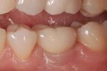 Figure 3 Buccal view of restoration.