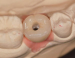 Figure 5 Completed restoration with occlusal access hole on laboratory model.