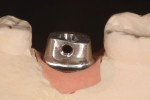 Figure 1 Cast custom abutment with lingual castable insert.
