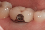 Figure 2 Lingual view of crown in place with lingual Straumann SCS screw.