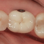 Figure 4 Occlusal view of restoration. Note how screw insert is flush with the lingual wall.