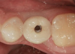 Figure 8 Restoration in patient’s mouth prior to placement of ceramic insert.