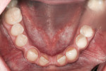 Figure 4 Preoperative photograph of the anterior mandible revealed inadequate bone volume in the areas of the missing teeth, as well as an overall excess of arch length.