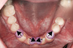 Figure 6 Planning for the mandibular tooth positioning allowed appropriate placement of natural teeth and preserved the bone that was present.