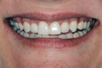 Figure 11 After all restorations had been placed, note the ideal gingival contours and natural appearance of the restorative–gingival interface.