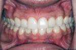 Figure 12 Excellent esthetics and ideal tooth shapes were evident in this postoperative close-up photograph of a broad smile.