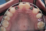 Figure 8 When the maxillary teeth were in the proper location, implants could be placed to allow adequate bone coverage and eventual esthetic restoration.