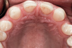 Figure 3 Preoperative photograph of the anterior maxilla showed inadequate spacing to place implants or restore natural teeth to esthetic contours.